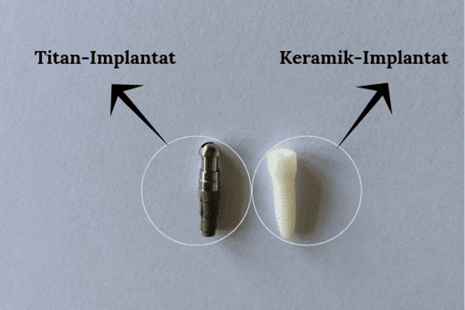 Vergleich: Titan-Implantat aus Metall neben einem weißen Keramik-Implantat